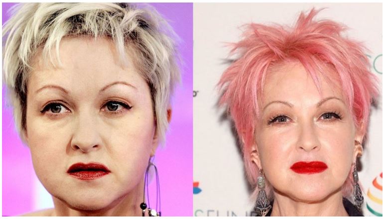 Cyndi Lauper's plastic surgery before and after