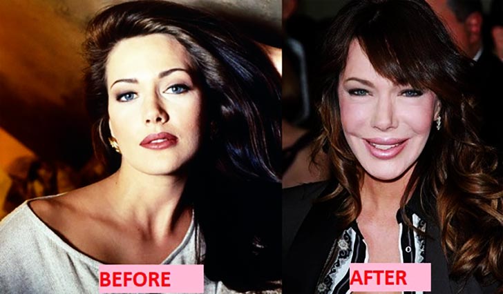 Hunter Tylo before and after surgery