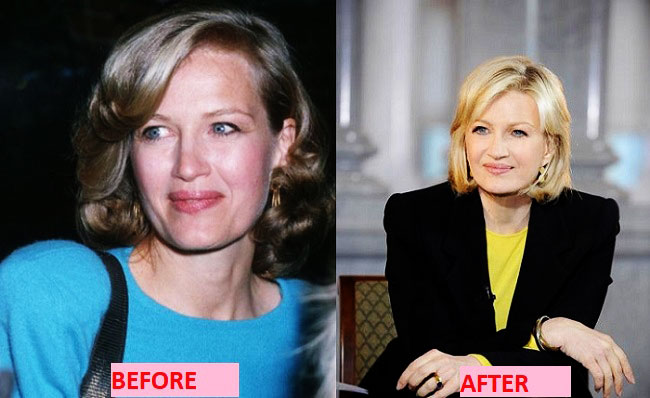 Diane Sawyer before and after photo