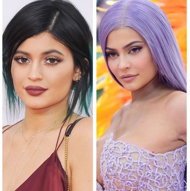 Kylie Jenner's plastic surgery face change over the years