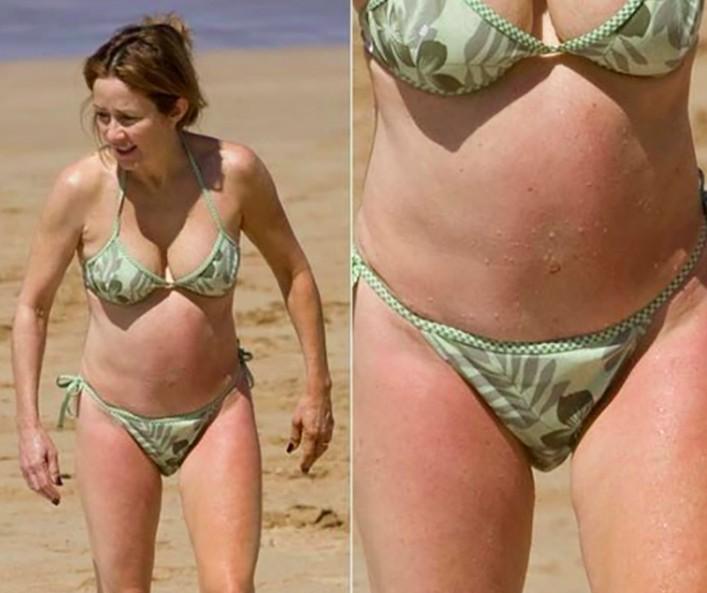 Patricia Heaton had tummy tuck