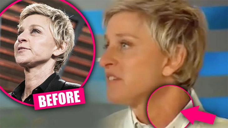 Has Ellen DeGeneres had plastic surgery